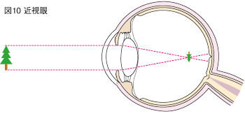 図10：近視眼