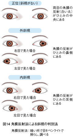 図14：角膜反射法による斜視の判別法